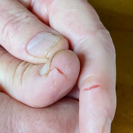 Fast relief and healing for deep cracks